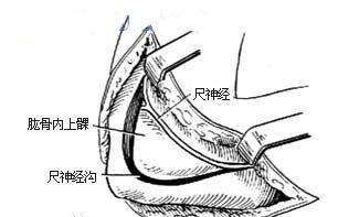 尺神經損傷的癥狀