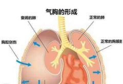 創(chuàng)傷性氣胸分為哪三類？