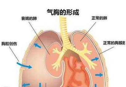 創傷性氣胸的示意圖