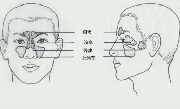 鼻竇支氣管綜合征的癥狀表現(xiàn)