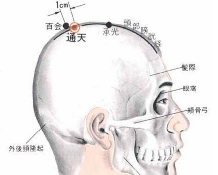 通天穴治療鼻炎