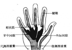 手掌深部間隙感染的預(yù)防措施有哪些？手掌深部間隙感染的治療
