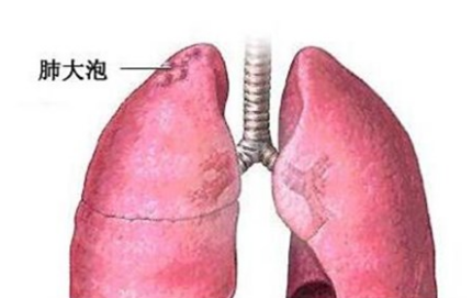 肺大泡的發病原因