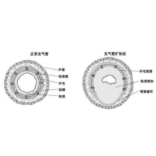 什么是肺囊性纖維化？肺囊性纖維化的癥狀表現及其治療方法有哪些？