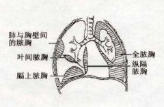 膽固醇膿胸的疾病鑒別及其護理方法！