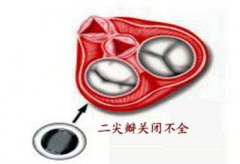 二尖瓣關(guān)閉不全是什么原因引起的？二尖瓣關(guān)閉不全食療方