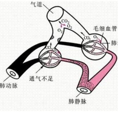 肺泡通氣低下綜合征如何診斷？它的癥狀表現及其治療方法有哪些？