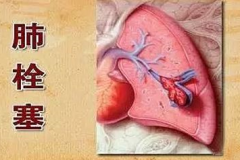 肺栓塞會猝死嗎？肺栓塞的癥狀表現(xiàn)及其護(hù)理方法！
