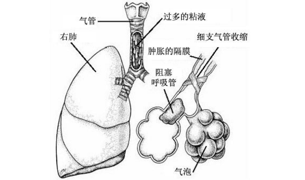 肺炎的發病原因
