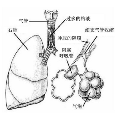 肺炎是由哪些原因引起的，其早期癥狀與治療方法有哪些？